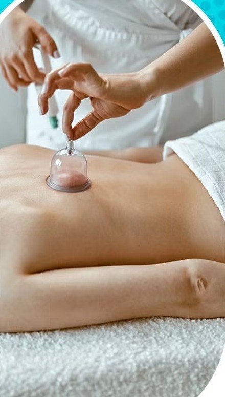 Terapia con ventosas